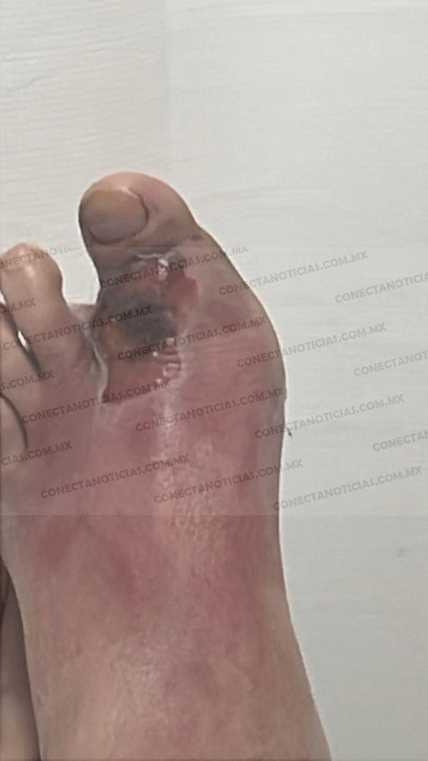 Denuncian negligencia médica en el ISSSTE de Camargo: paciente con mordedura de serpiente no recibió atención oportuna